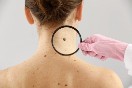 Precisan diagnósticos de cáncer de piel de tipo melanoma con Inteligencia Artificial